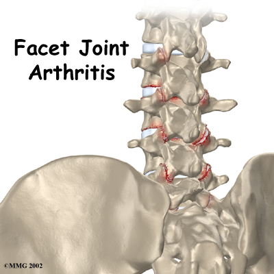 Lumbar Facet Joint Arthritis