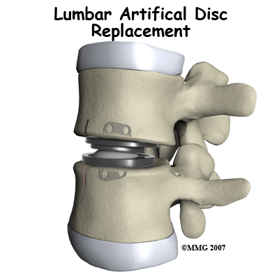 Lumbar Artificial Disc Replacement